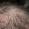 16 Foods That Stop Hair Loss: Hair Loss Diet