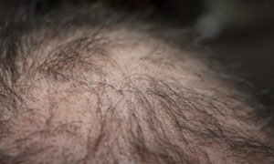 16 Foods That Stop Hair Loss: Hair Loss Diet