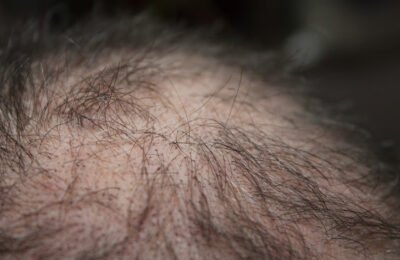 16 Foods That Stop Hair Loss: Hair Loss Diet