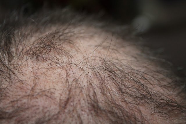 16 Foods That Stop Hair Loss: Hair Loss Diet