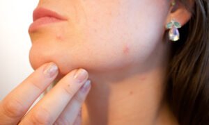 29 Effective Home Remedies for Acne That Work Overnight Fast