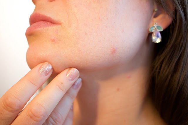 29 Effective Home Remedies for Acne That Work Overnight Fast