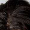 11 Working Ways to Clear Dandruff Naturally Fast
