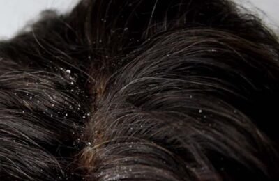 11 Working Ways to Clear Dandruff Naturally Fast