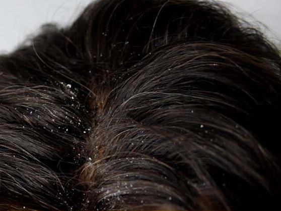 11 Working Ways to Clear Dandruff Naturally Fast