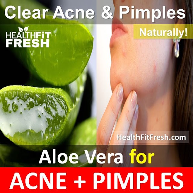 How To Use Aloe Vera To Clear Acne Overnight Fast