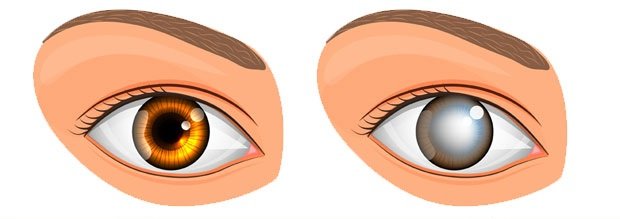 11 Safe & Effective Home Remedies for Cataract Removal