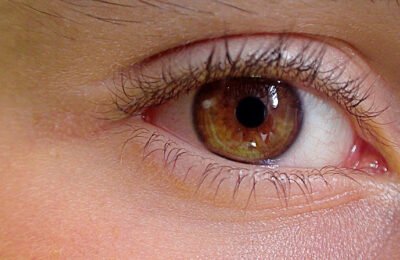 11 Safe & Effective Home Remedies for Cataract Removal