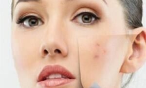 DIY Face Masks to Get Rid of Acne Overnight Fast