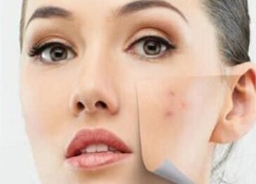 DIY Face Masks to Get Rid of Acne Overnight Fast