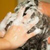 How To Prevent Pimples Due To Dandruff