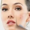 8 Remedies to Get Rid of Cystic Acne Overnight Fast