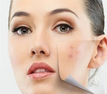 8 Remedies to Get Rid of Cystic Acne Overnight Fast