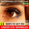 13 Ways to Get Rid of Under Eye Wrinkles (Crow’s Feet) Overnight Fast