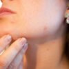 3 Best Home Remedies For Acne Treatment Fast Overnight