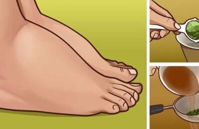 3 Ways to Get Rid of Swollen Feet And Ankles Naturally: Edema Treatment