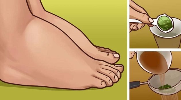 3 Ways to Get Rid of Swollen Feet And Ankles Naturally: Edema Treatment