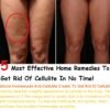5 Effective Home Remedies To Get Rid Of Cellulite