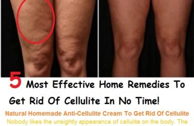 5 Effective Home Remedies To Get Rid Of Cellulite