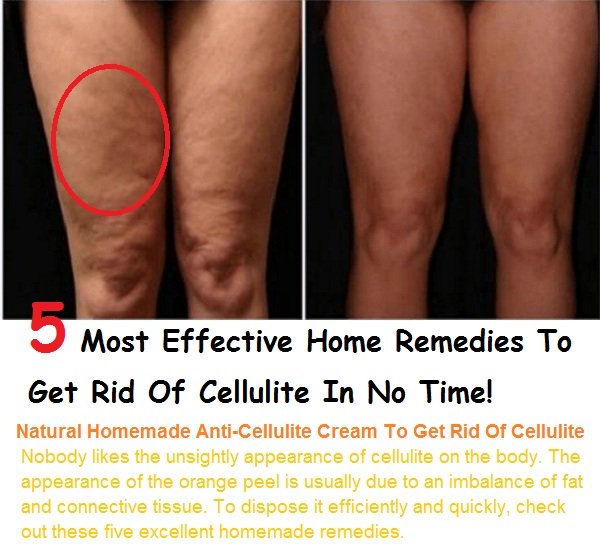 5 Effective Home Remedies To Get Rid Of Cellulite
