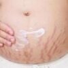 How To Get Rid Of Stretch Marks With Lemon