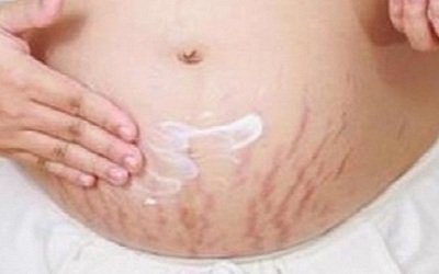 How To Get Rid Of Stretch Marks With Lemon