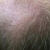 How To Stop Hair Loss In Men: Treatments and Solutions