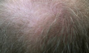 How To Stop Hair Loss In Men: Treatments and Solutions