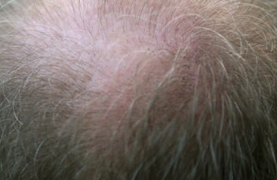 How To Stop Hair Loss In Men: Treatments and Solutions