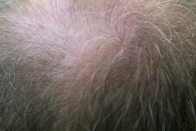 How To Stop Hair Loss In Men: Treatments and Solutions