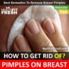 How to Get Rid of Pimples on Breast Overnight Fast