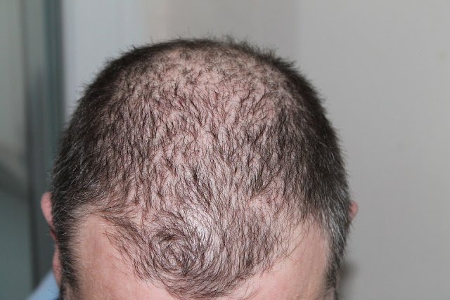 3 Powerful Ways To Stop Hair Loss Naturally